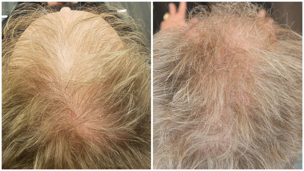Virtual Hair Restoration Consultation & Scalp Analysis